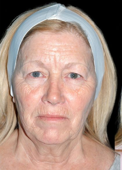 Facelift Before & After Patient #12647