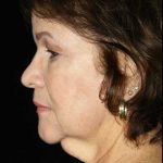 Facelift Before & After Patient #12685