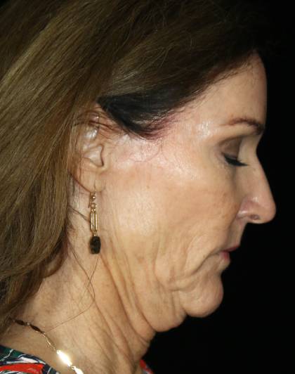 Facelift Before & After Patient #12676