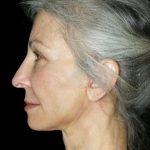 Mini Facelift Before & After Patient #12733