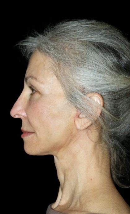 Mini Facelift Before & After Patient #12733
