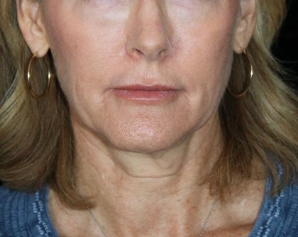 Facelift Before & After Patient #12822