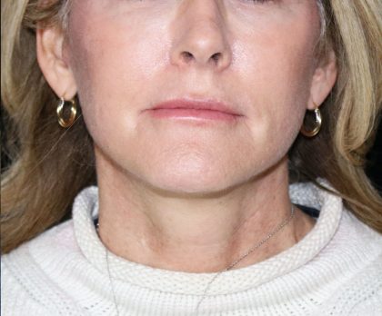 Facelift Before & After Patient #12822