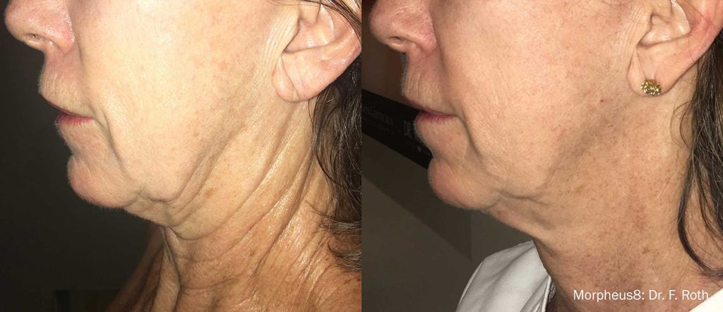 Morpheus8 treatment before and after.  Dr. Steven R. Cohen of Face Plus, San Diego, CA.