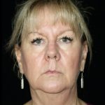 Facelift Before & After Patient #13042