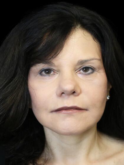 Facelift Before & After Patient #13035