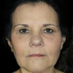 Facelift Before & After Patient #13035