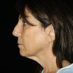 Facelift Before & After Patient #13182